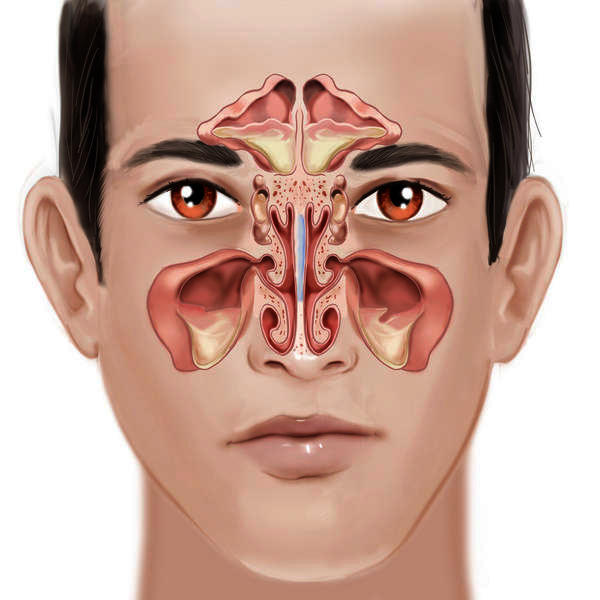 What is a sinusitis infection?